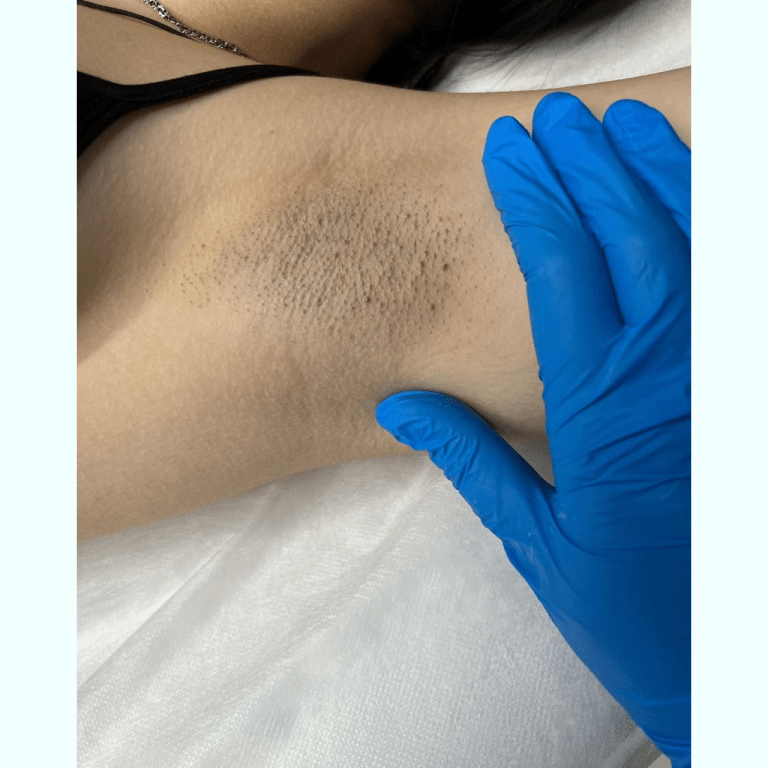Laserová epilace chloupků na bradě obrázek 5