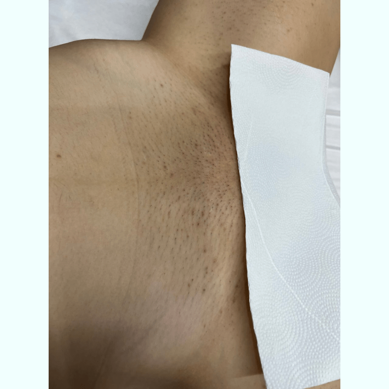 Laserová epilace chloupků na bradě obrázek 13