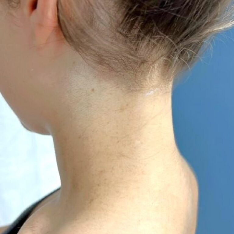 Фото шия без волосся після лазерної епіляції