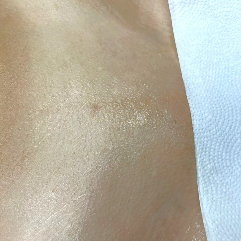 Laser hair removal Bikini area