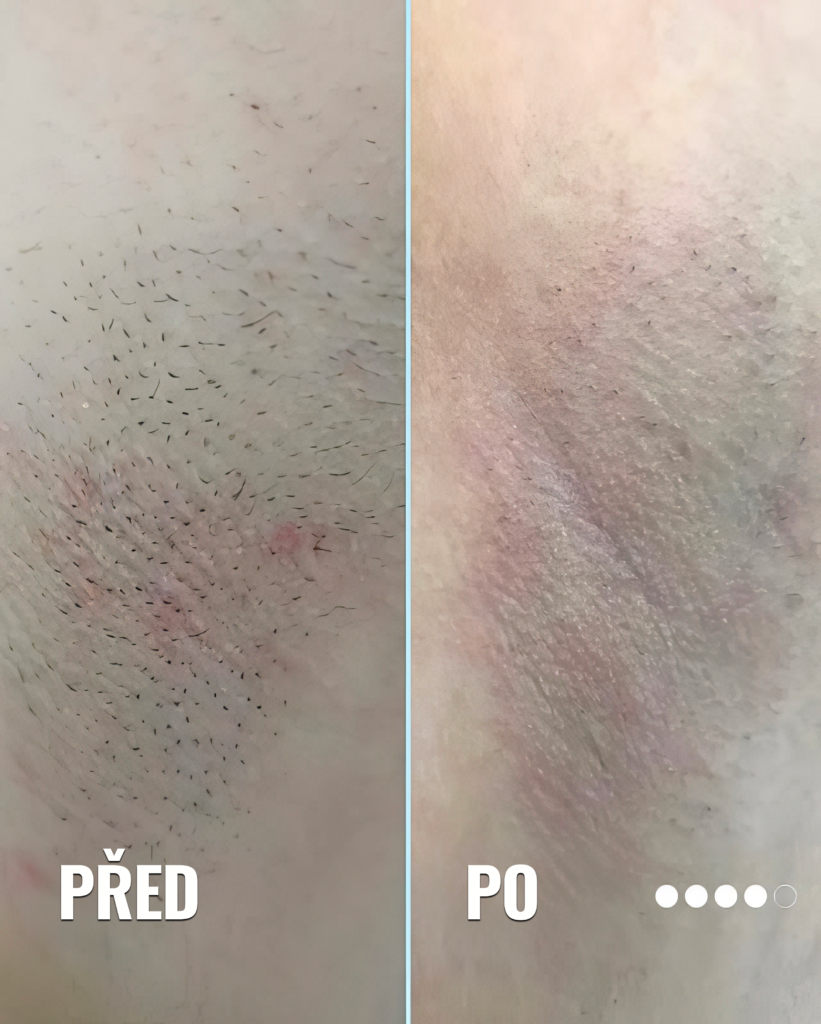 Laserové odstranění chloupků. Epilace laserem Praha. obrázek 2 Laserové odstranění chloupků. Epilace laserem Praha. obrázek 1