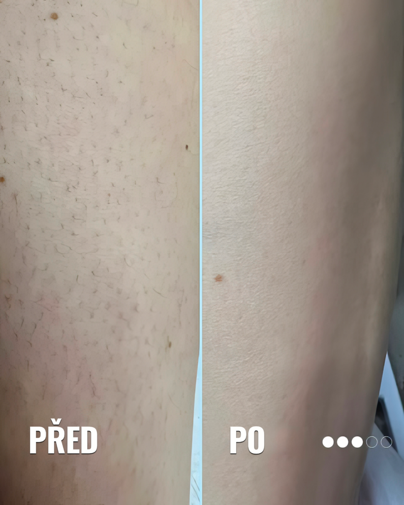 Laserové odstranění chloupků. Epilace laserem Praha. obrázek 3 Stehno před a po laserové epilaci – výrazné snížení množství chloupků a hladší pokožka po ošetření
