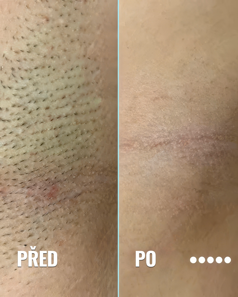 Laserové odstranění chloupků. Epilace laserem Praha. obrázek 5 „Podpaží před a po laserové epilaci – výrazné snížení množství chloupků a hladší pokožka po ošetření