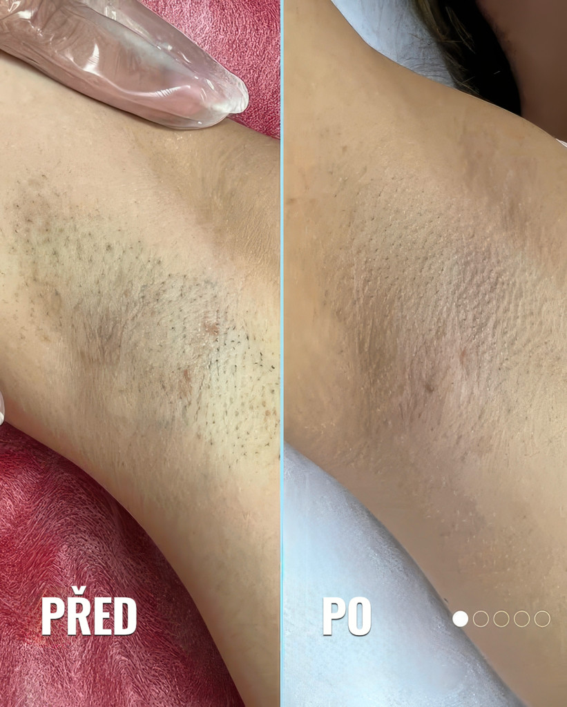 Laserové odstranění chloupků. Epilace laserem Praha. obrázek 6 Podpaží před a po laserové epilaci – výrazné snížení množství chloupků a hladší pokožka po ošetření